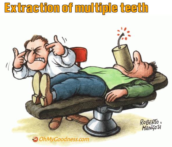 : Extraction of multiple teeth